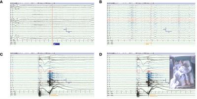 Clinical features in antiglycine receptor antibody-related disease: a case report and update literature review